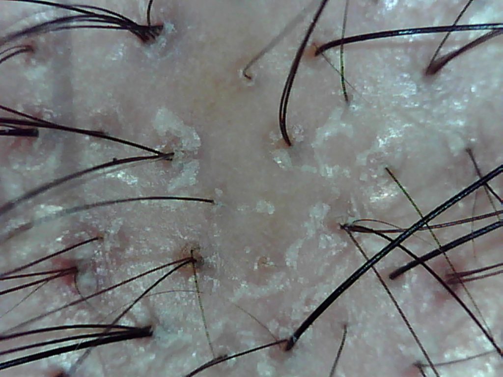 乾燥する季節 頭皮トラブル 抜け毛の関係性