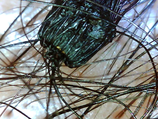 毛穴の汚れ 頭皮 植毛 ハゲ