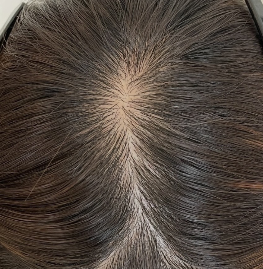 抜け毛対策