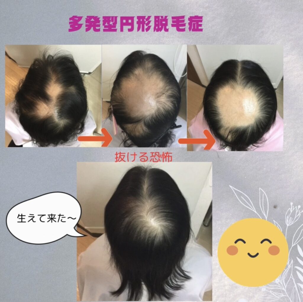 多発型円形脱毛症