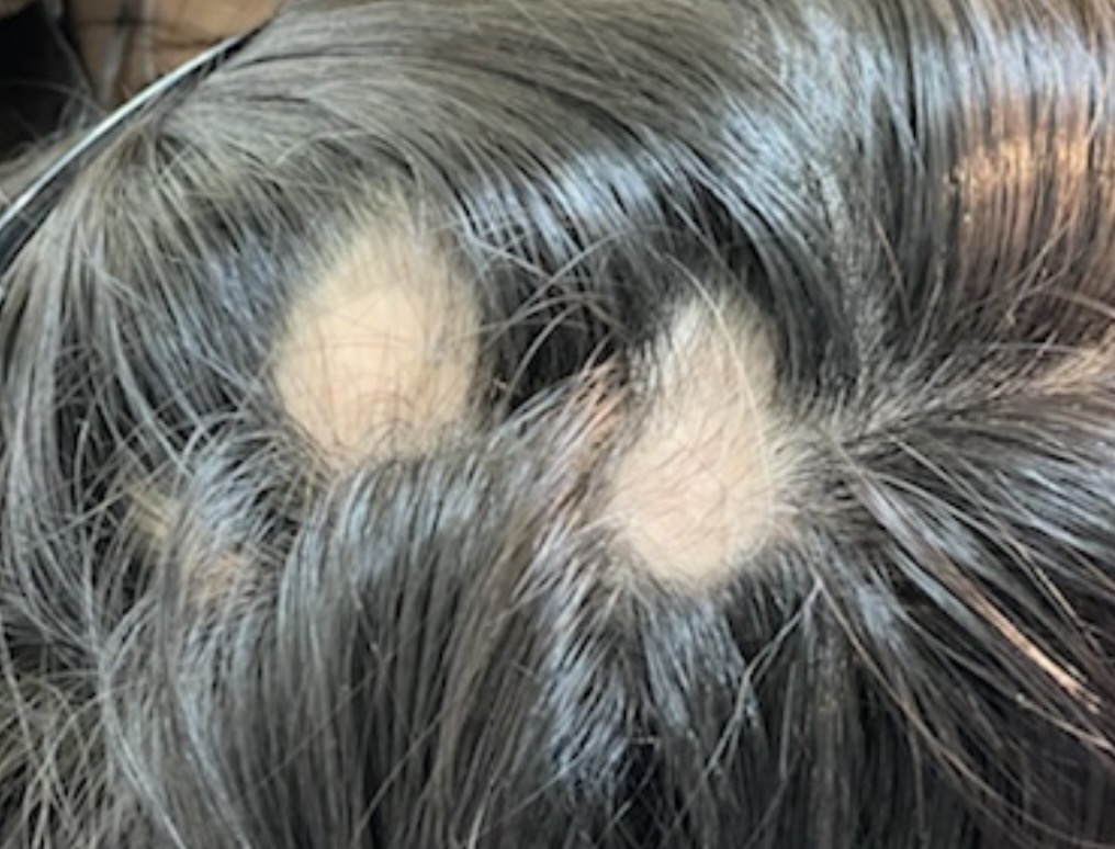 多発型円形脱毛症