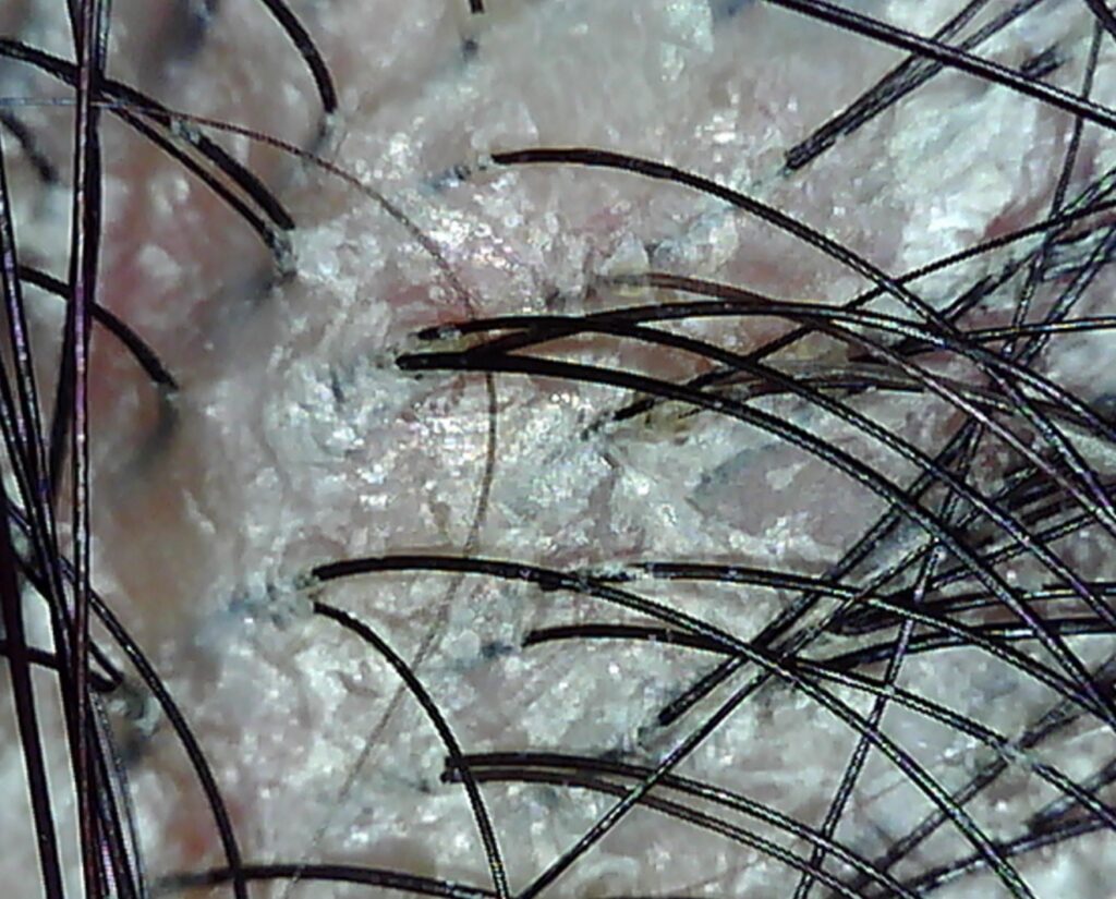 びまん性脱毛症